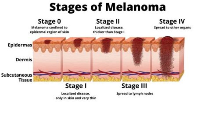 Can melanoma spread after being removed?